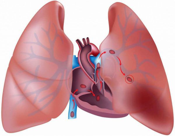 Тромбоемболія легеневої артерії