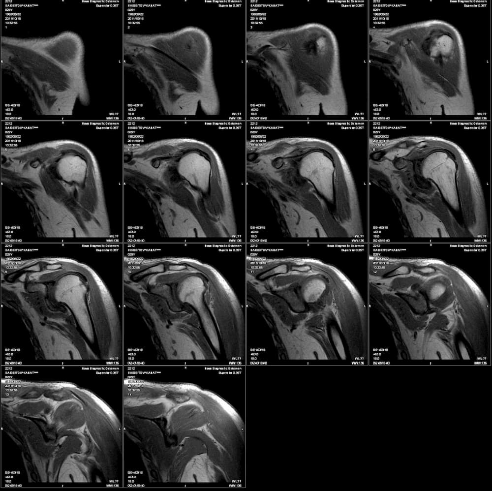 Пошарові знімки при проведенні комп'ютерної томографії для діагностики плечового плекситу