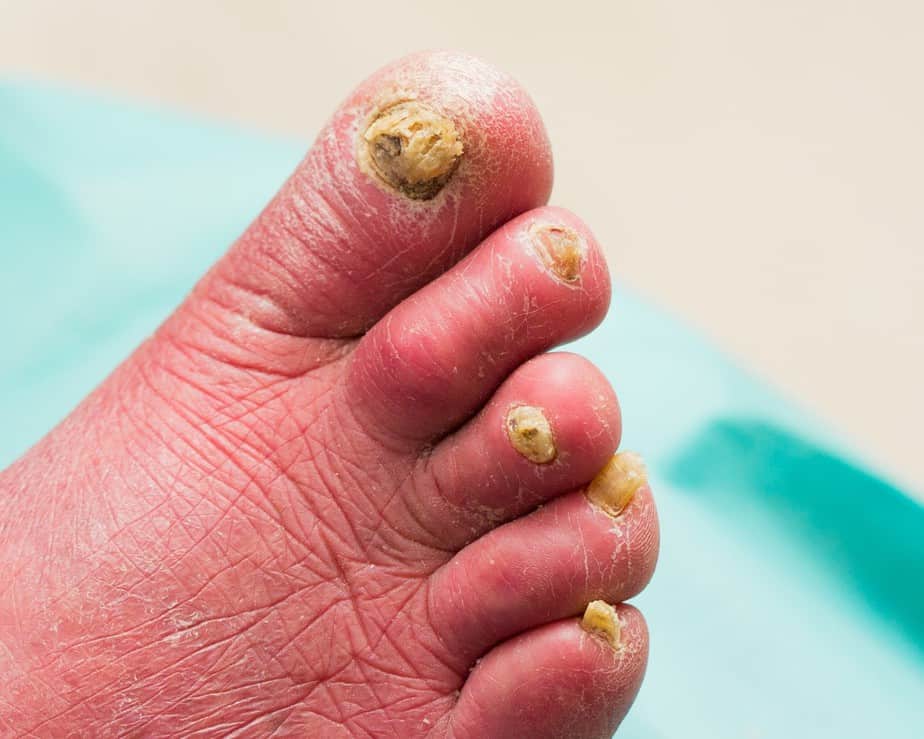 На малюнку типові симптоми запущеного грибка нігтів.