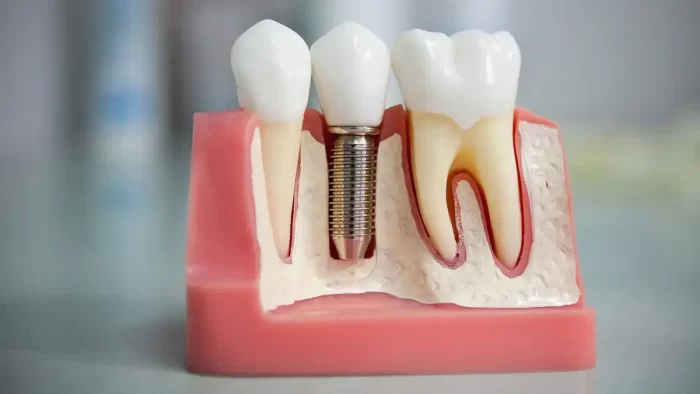 Протезування зубів: які методи використовуються сьогодні