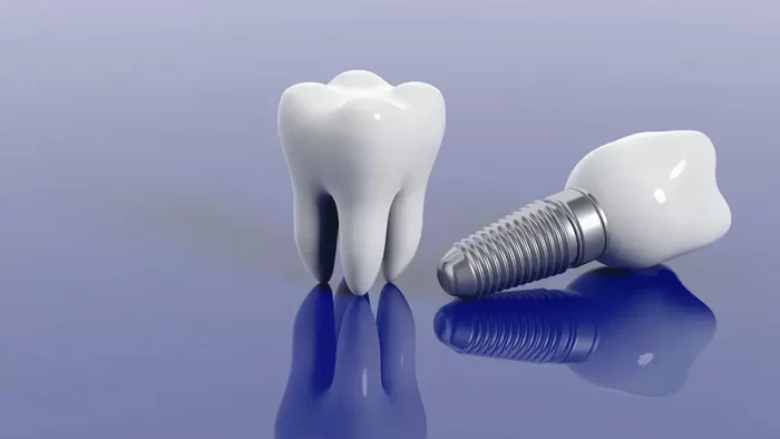 Імплантація зубів: ціни послуги та основні переваги