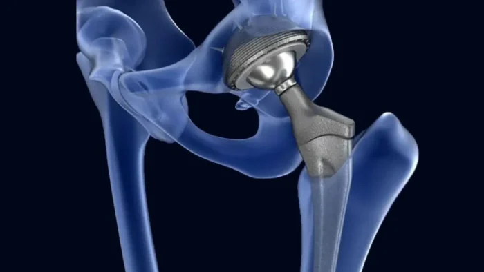 Ендопротезування суглобів: коли операція стає необхідністю